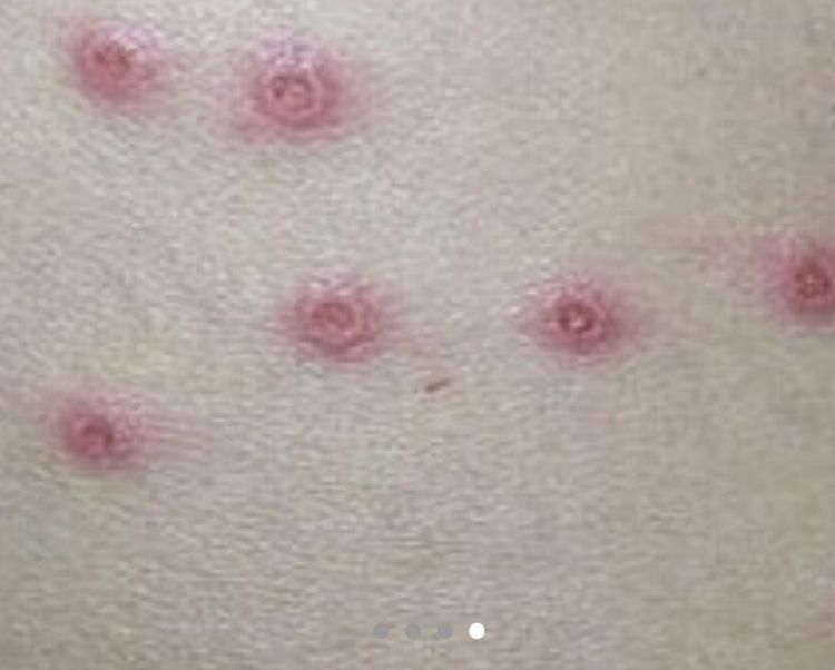 带你认识水痘——水痘的初发症状及图片