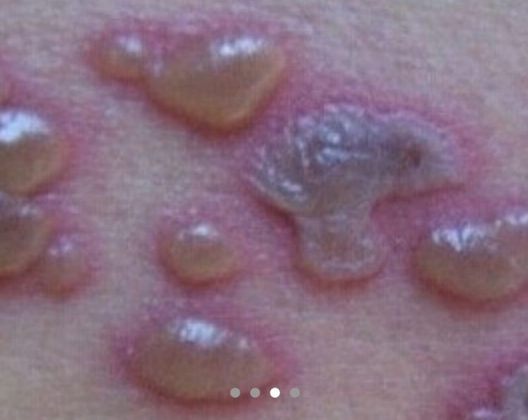带你认识水痘——水痘的初发症状及图片